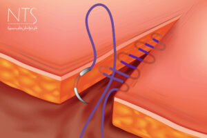 کاربرد انواع نخ بخیه