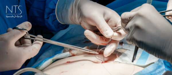 نخ بخیه ویکریل رپید