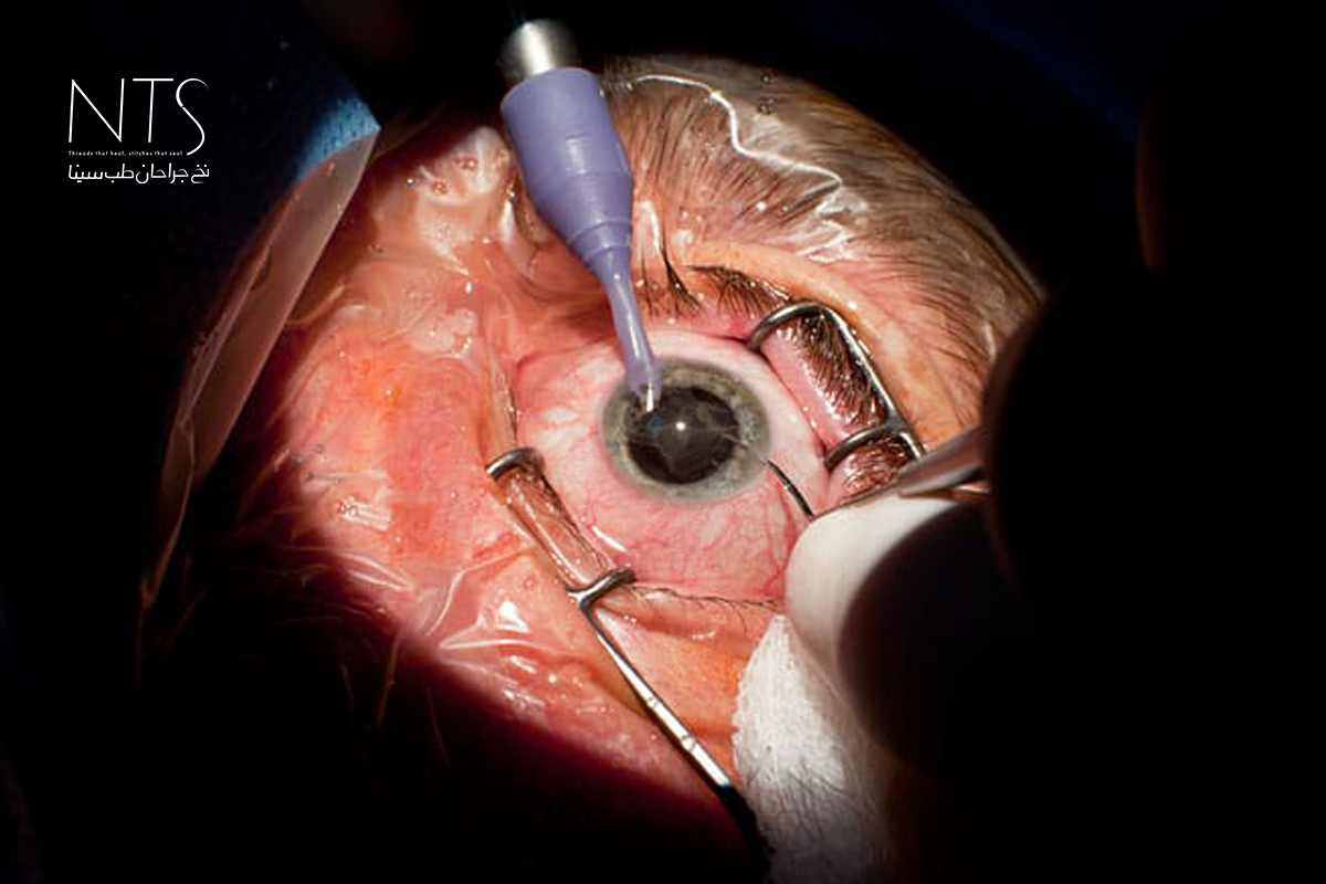 آموزش درون سازمانی جراحی چشم