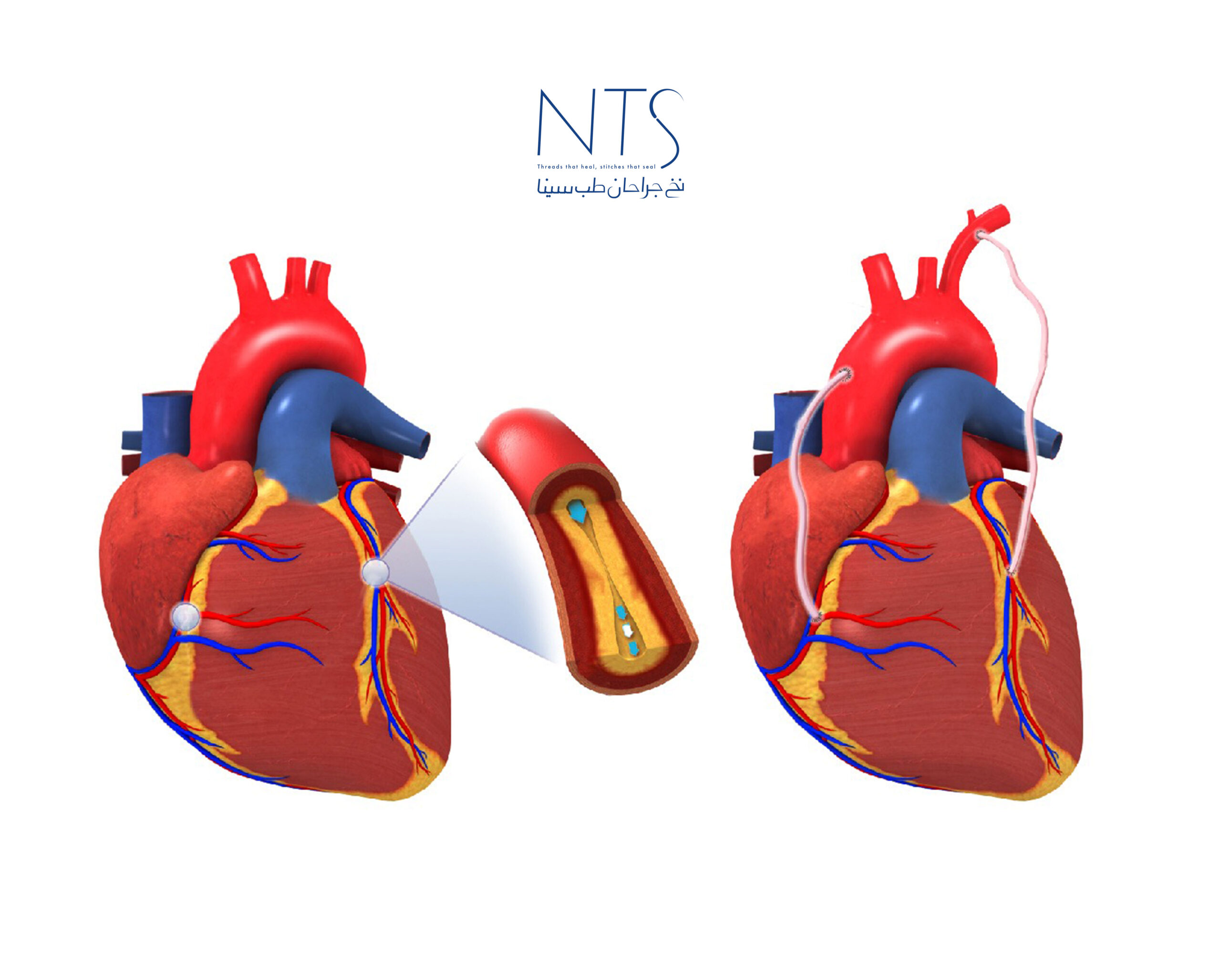 عمل جراحی CABG
