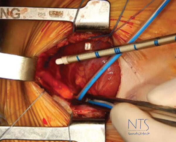 بخیه با نخ پلی پروپیلن