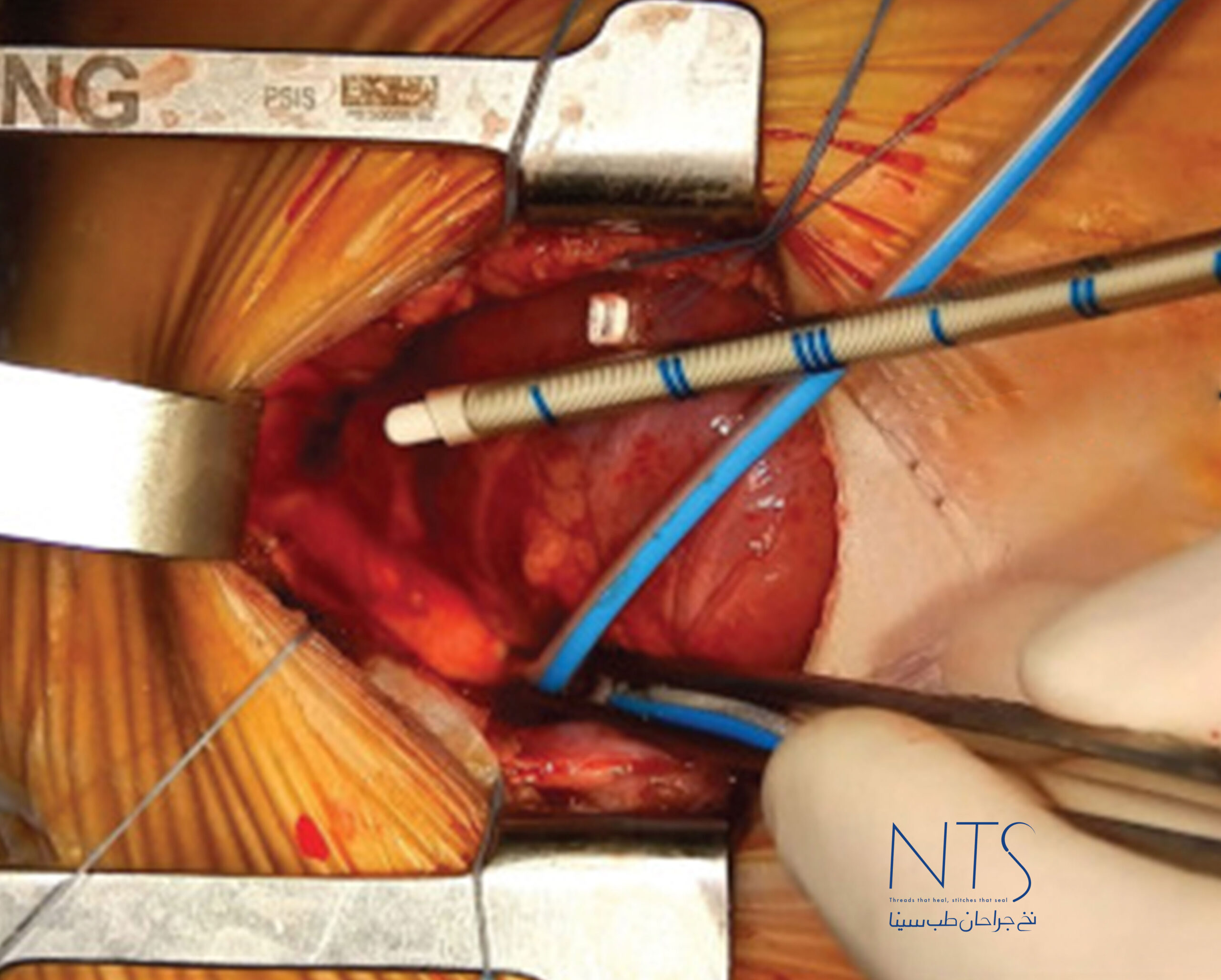 بخیه با نخ پلی پروپیلن